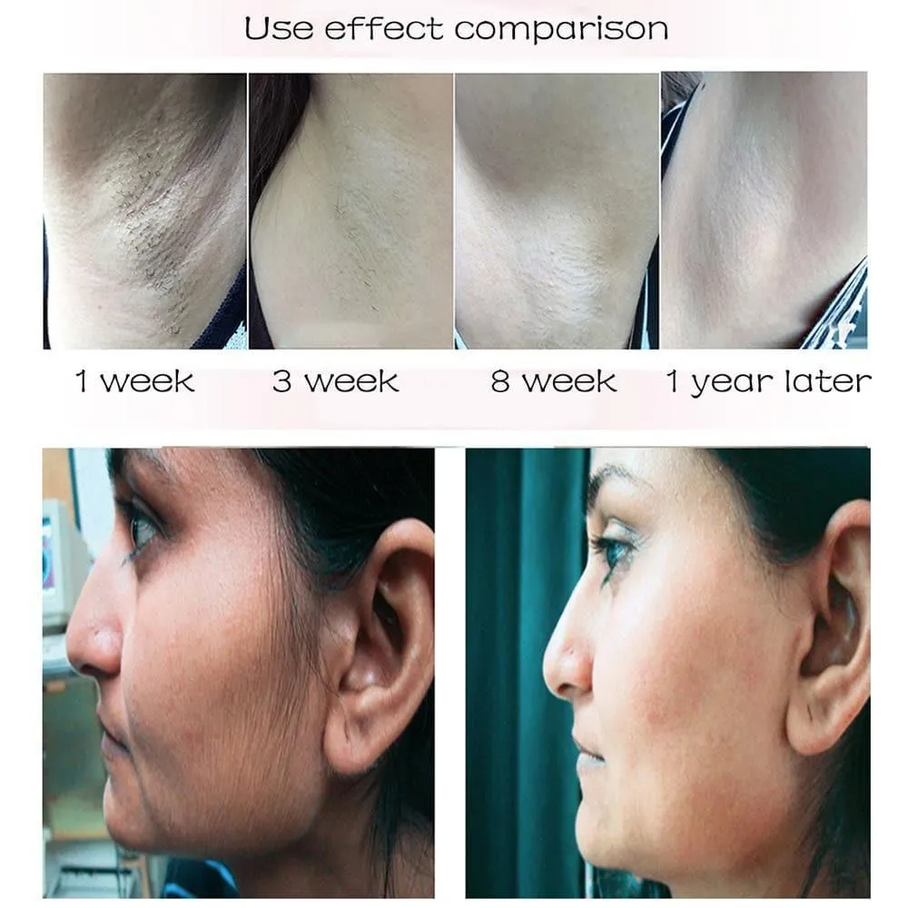Upgraded IPL Laser Hair Removal - Flash Epilator
